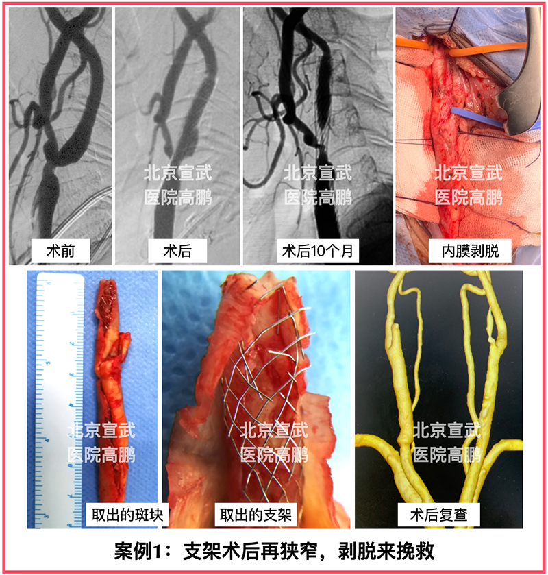 一個常見的話題:頸動脈支架術後再狹窄,該怎麼辦?首選內膜剝脫來挽救.