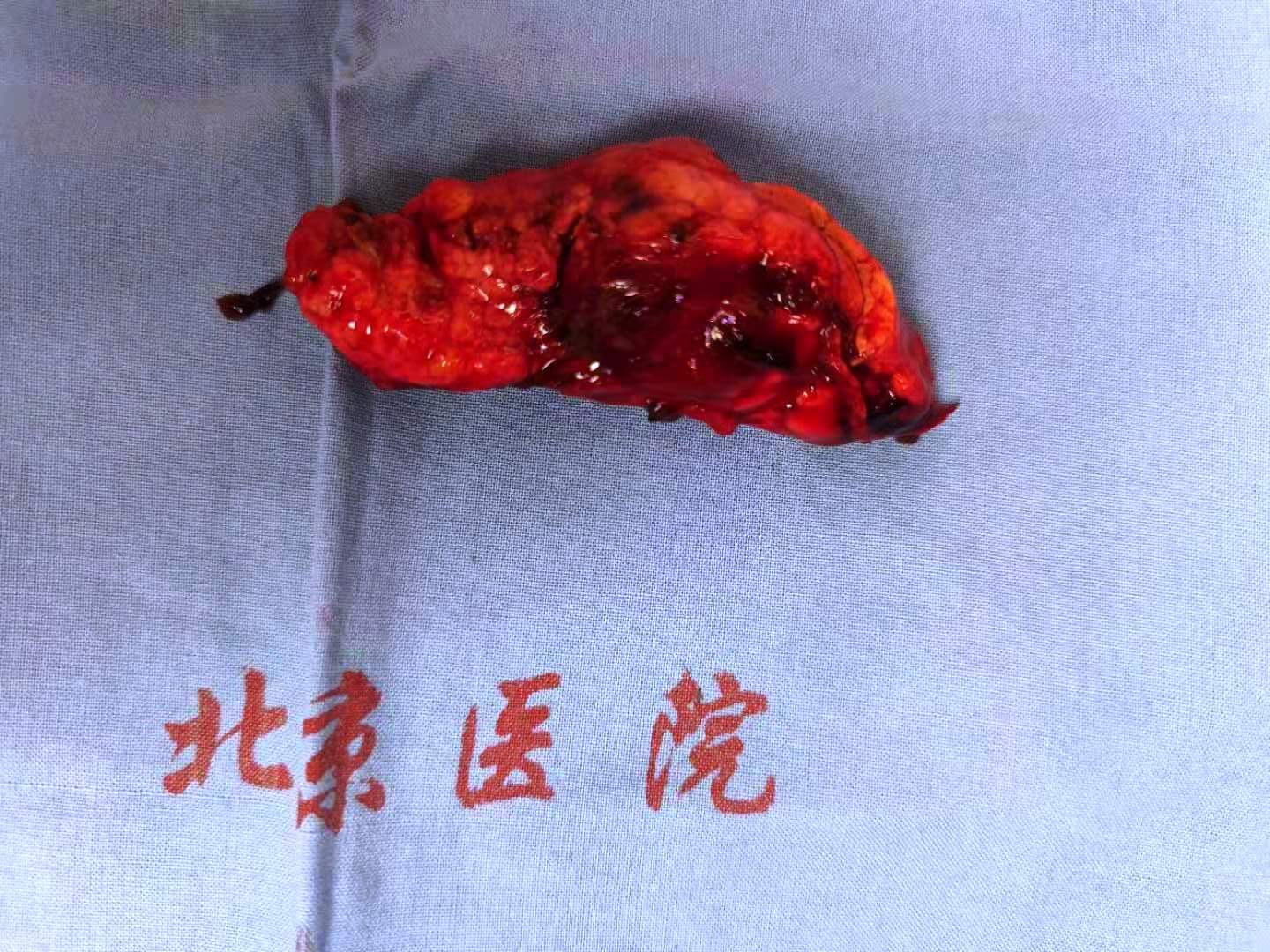 能不能保留脾脏?_胰腺癌_介绍_治疗方式 - 好大夫在线