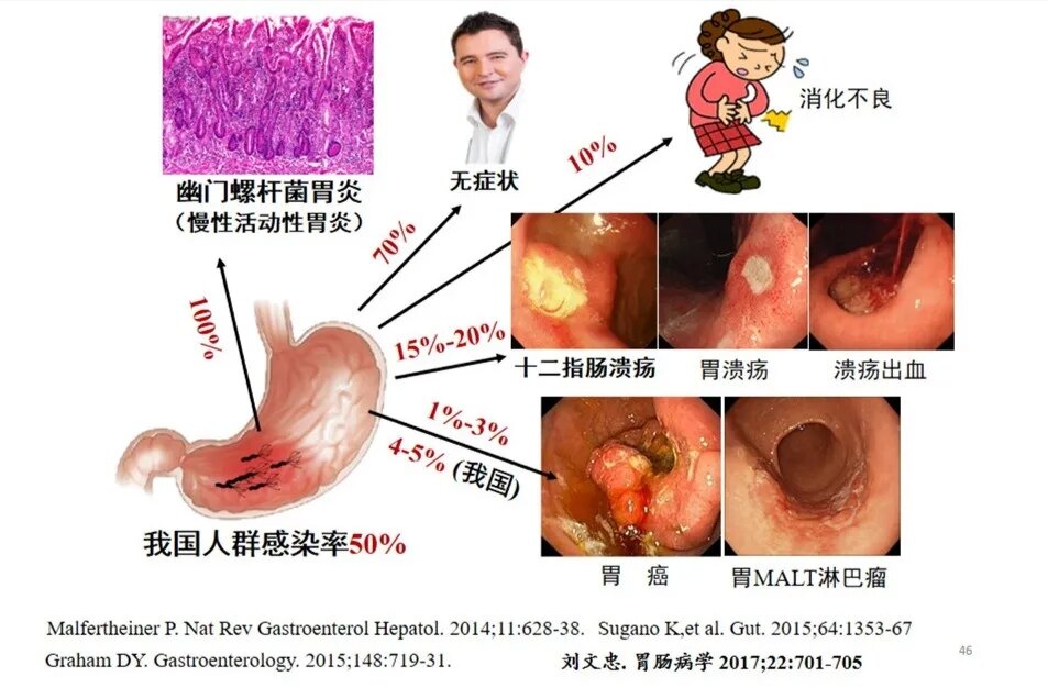 根除幽门螺杆菌可防胃癌!不同阶段,受益不同!