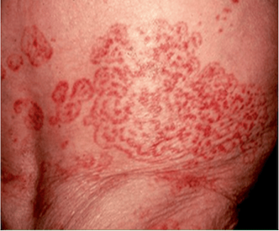 皮肤上的癌症密码之八:匐行性回状红斑