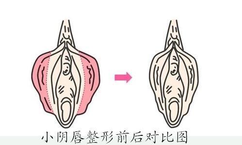 阴唇整形有哪些方法呢手术安全吗