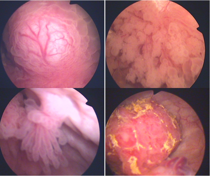 膀胱癌菜花状图片图片