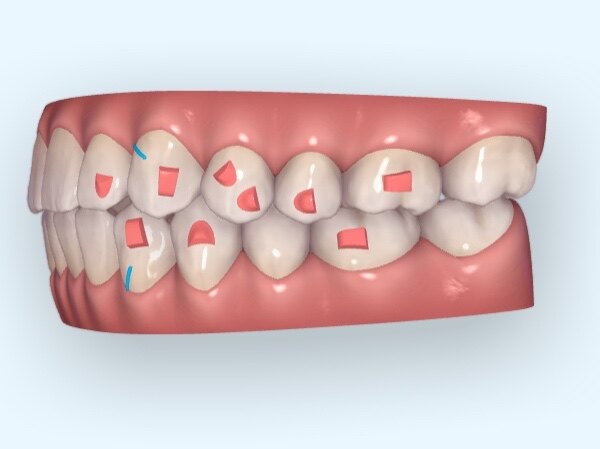 隐形牙套上附件的形状怎么都不一样?