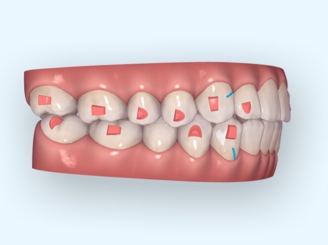 隐形牙套上附件的形状怎么都不一样?