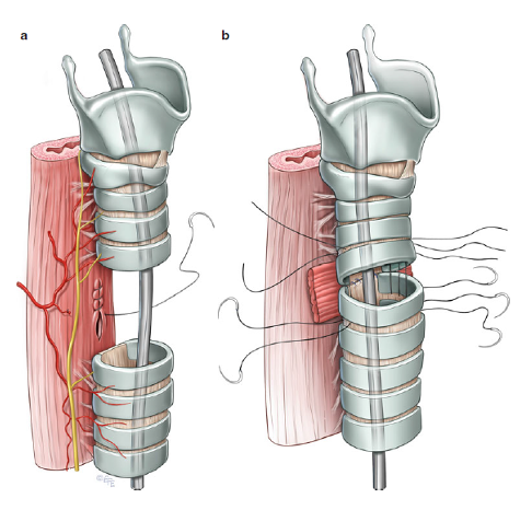 食管气管瘘分型图片
