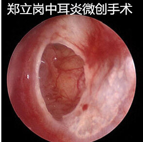 鼓膜大穿孔手術難嗎