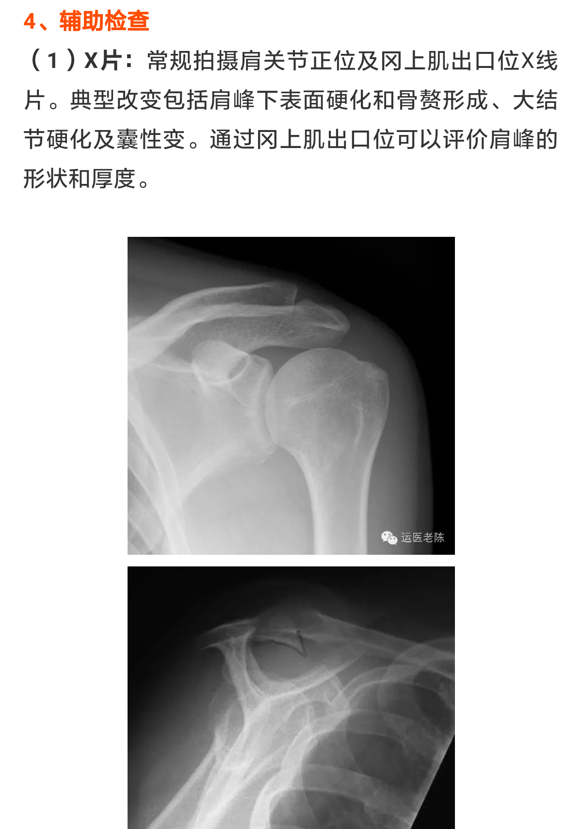 肩痛:肩峰下撞击综合征～诊治要点(专业版) - 好大夫在线