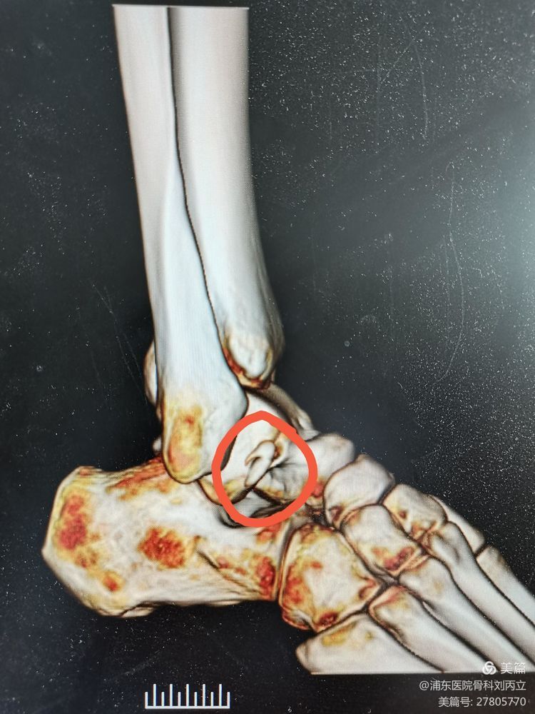 踝扭伤经常伴随距腓前韧带的损伤 