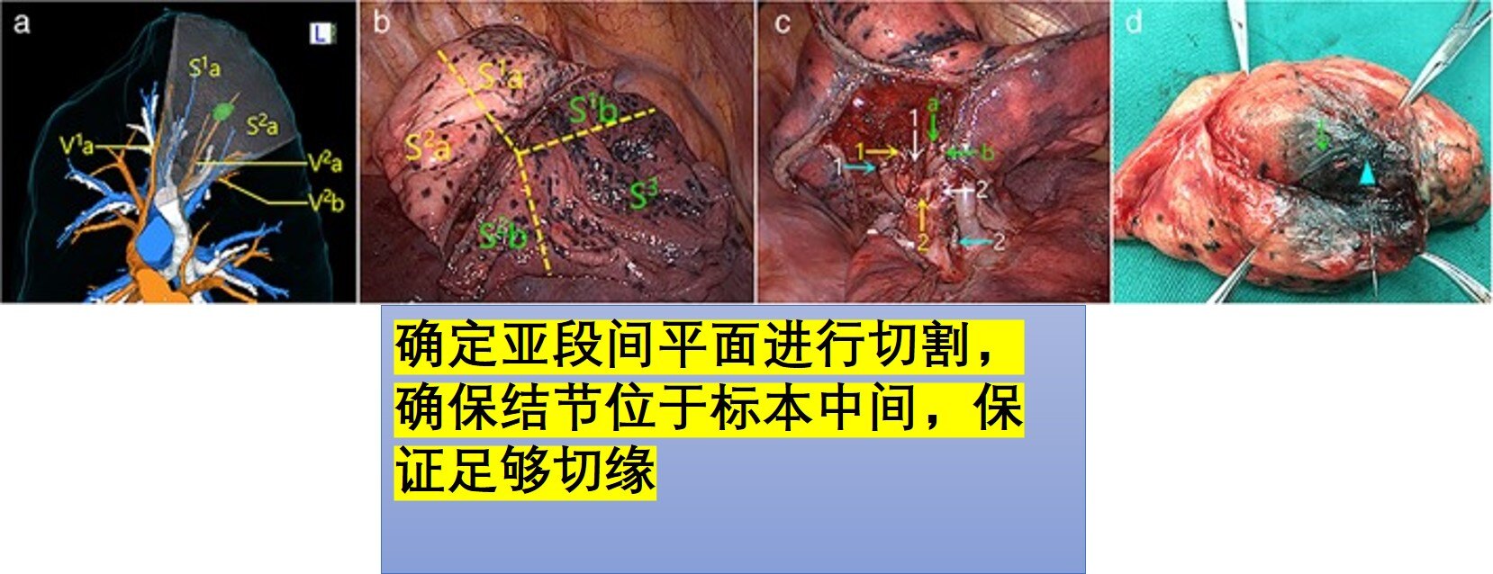 肺结节手术示意图图片