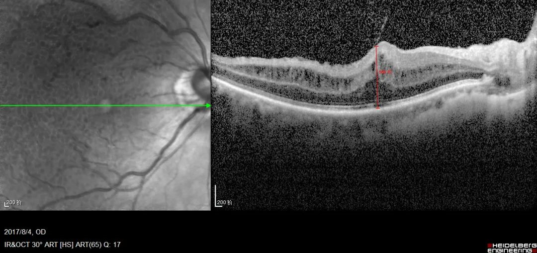 术后黄斑部oct显示前膜已被完整剥除,见下图