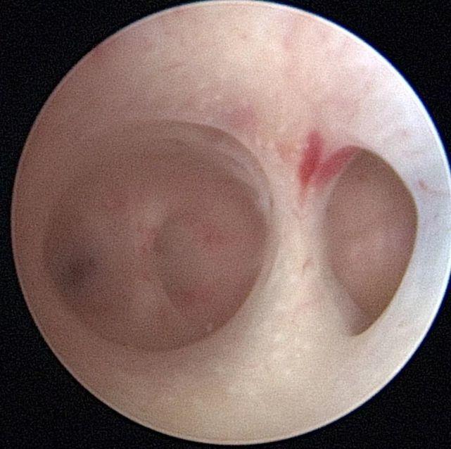 (10)不明原因性不孕(9)子宫内膜炎性病变确诊(8)两次ivf-et失败(7)