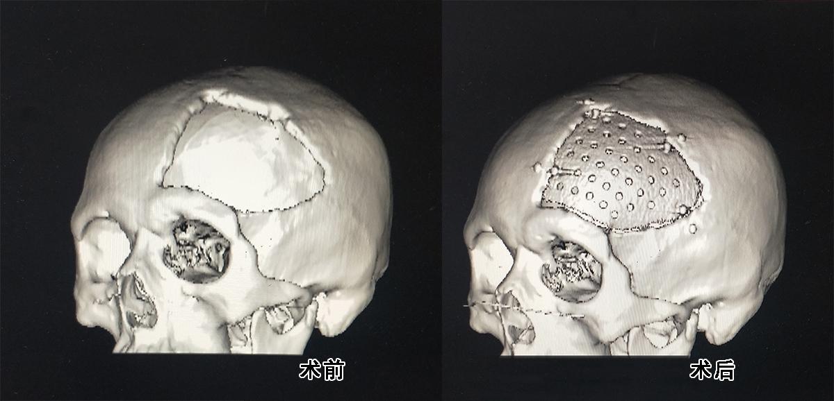 peek顱骨修復整形術後,患者頭顱恢復原貌另外,經過修復手術治療,劉
