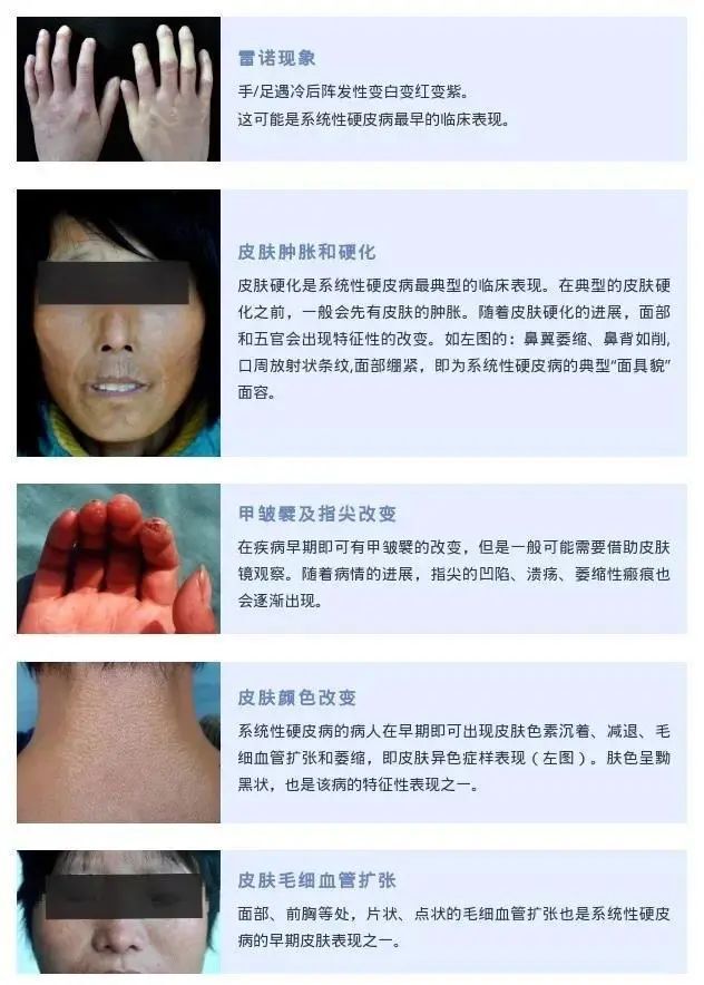 系统性硬皮病与局限性硬皮病(也称硬斑病)可能不是同一种疾病.