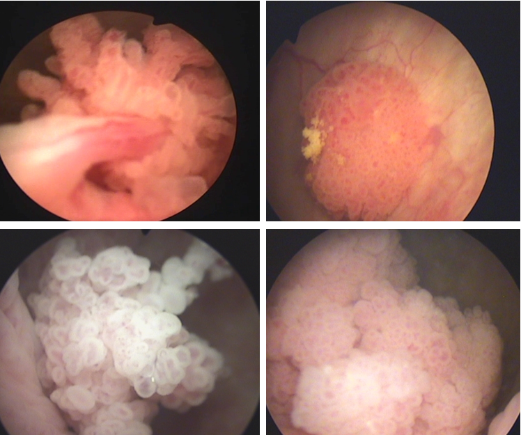 菜花状膀胱肿瘤图片图片
