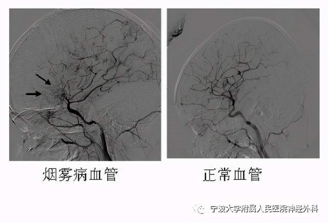烟雾病_介绍_症状表现_治疗方式 - 好大夫在线
