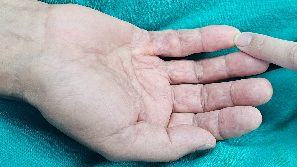 掌腱膜挛缩科普