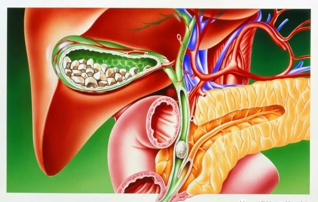 发生胆囊结石,胆囊结石可以嵌顿到胆囊颈部或胆管内引起胆汁排泄受阻