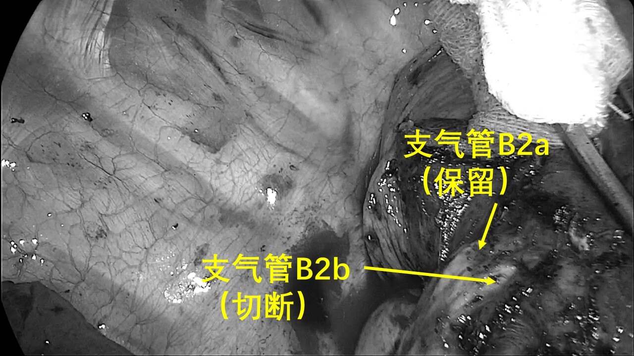 從肺葉切除,到肺段切除,再到聯合亞段切除,體現出胸外科醫生精益求精