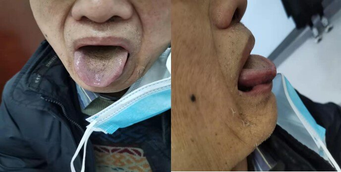 胃癌术后食不下,中医中药来帮忙 - 好大夫在线