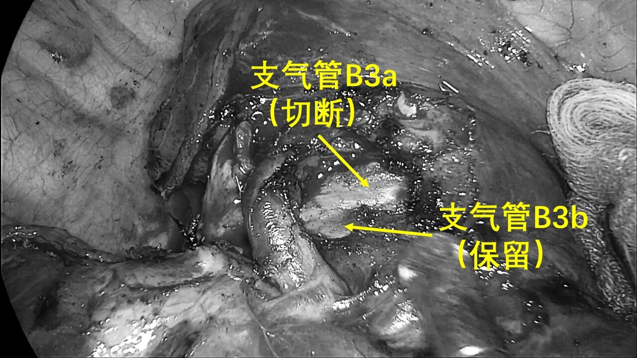 肺小結節磨玻璃結節手術治療的時間窗磨玻璃結節什麼時候手術最合適