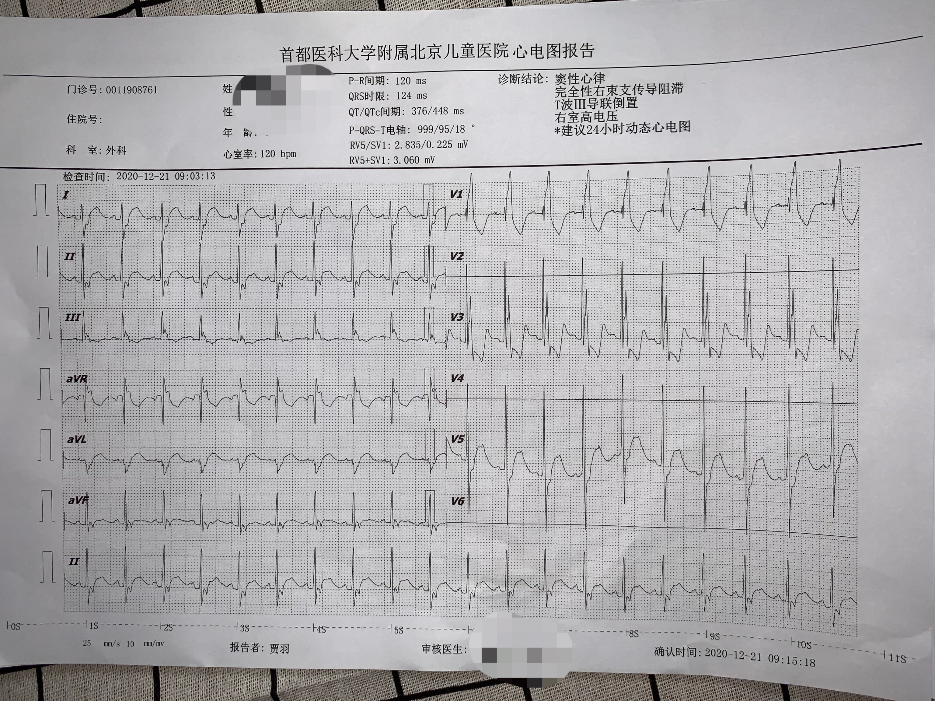 儿童心肌炎心电图图片