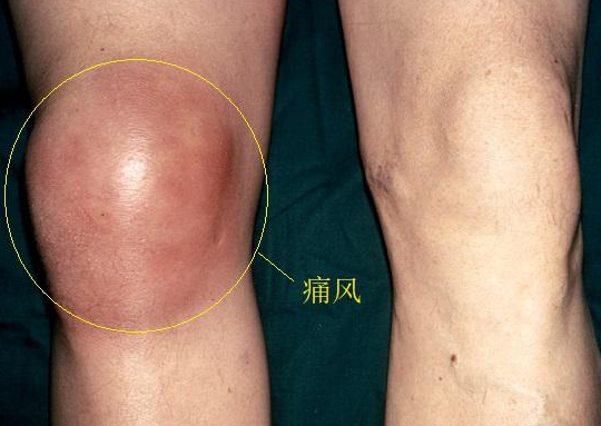 膝关节积液是怎么产生的