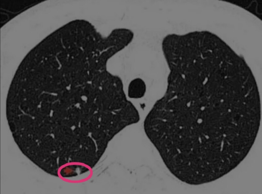 肺部实性结节 良性图片