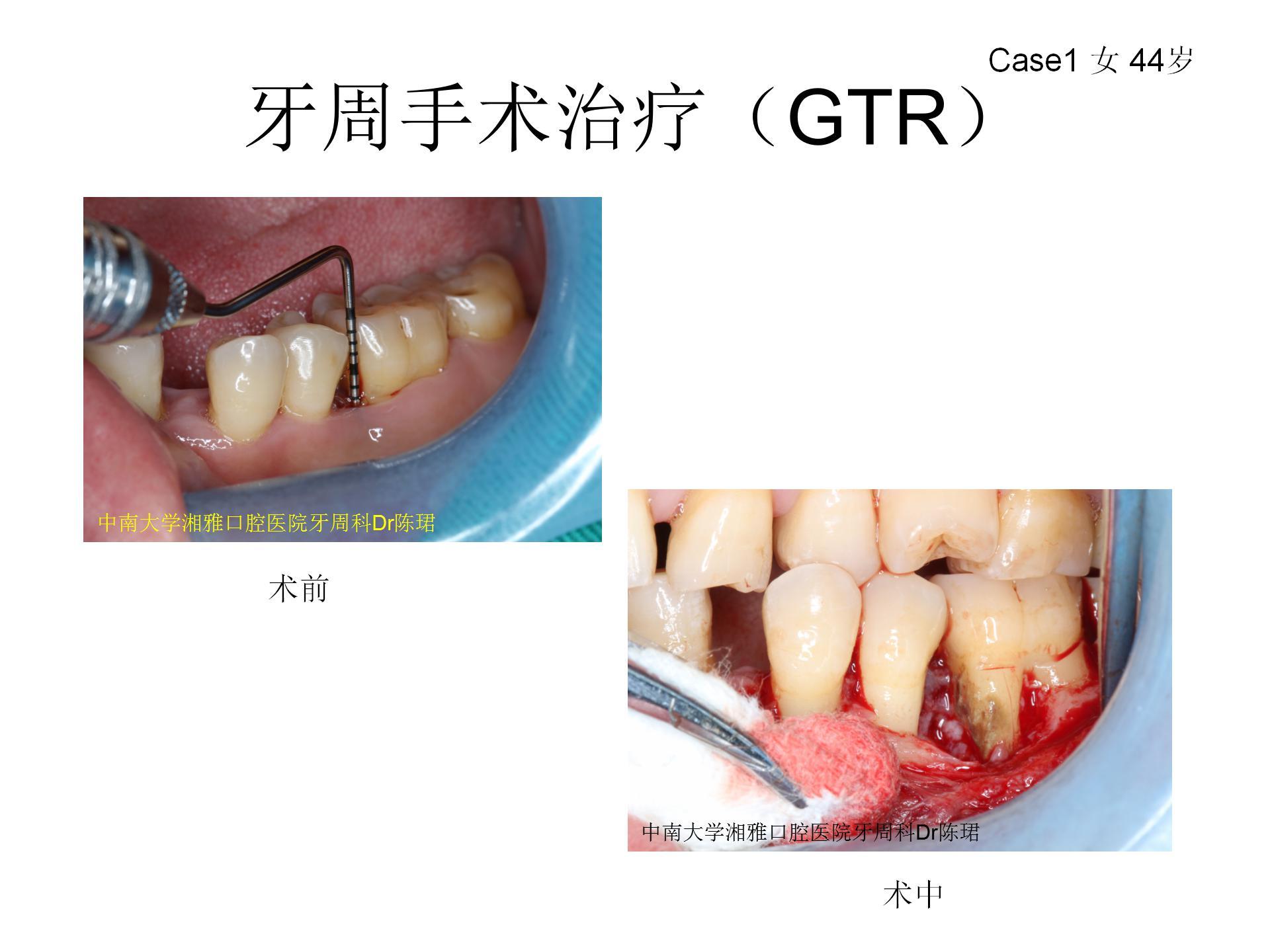 什么是牙周翻瓣术 Gtr术 牙周炎