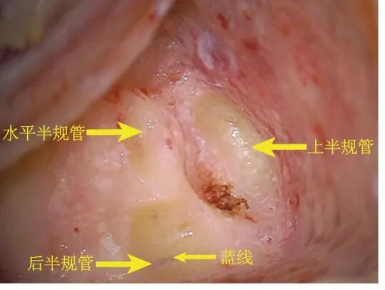 半规管位置.jpg