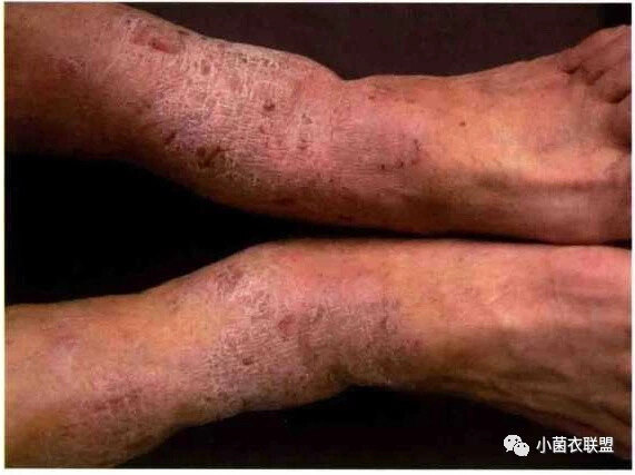 关于湿疹你究竟了解多少 湿疹