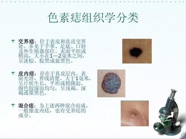 身上长了黑痣,到底该不该治疗?_介绍_治疗方式_相关疾病 - 好大夫在线