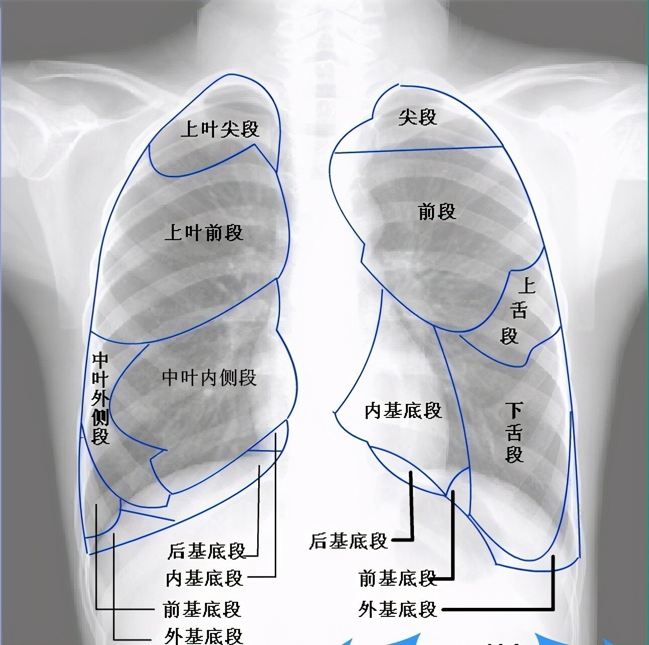 正常肺ct片图片图解图片
