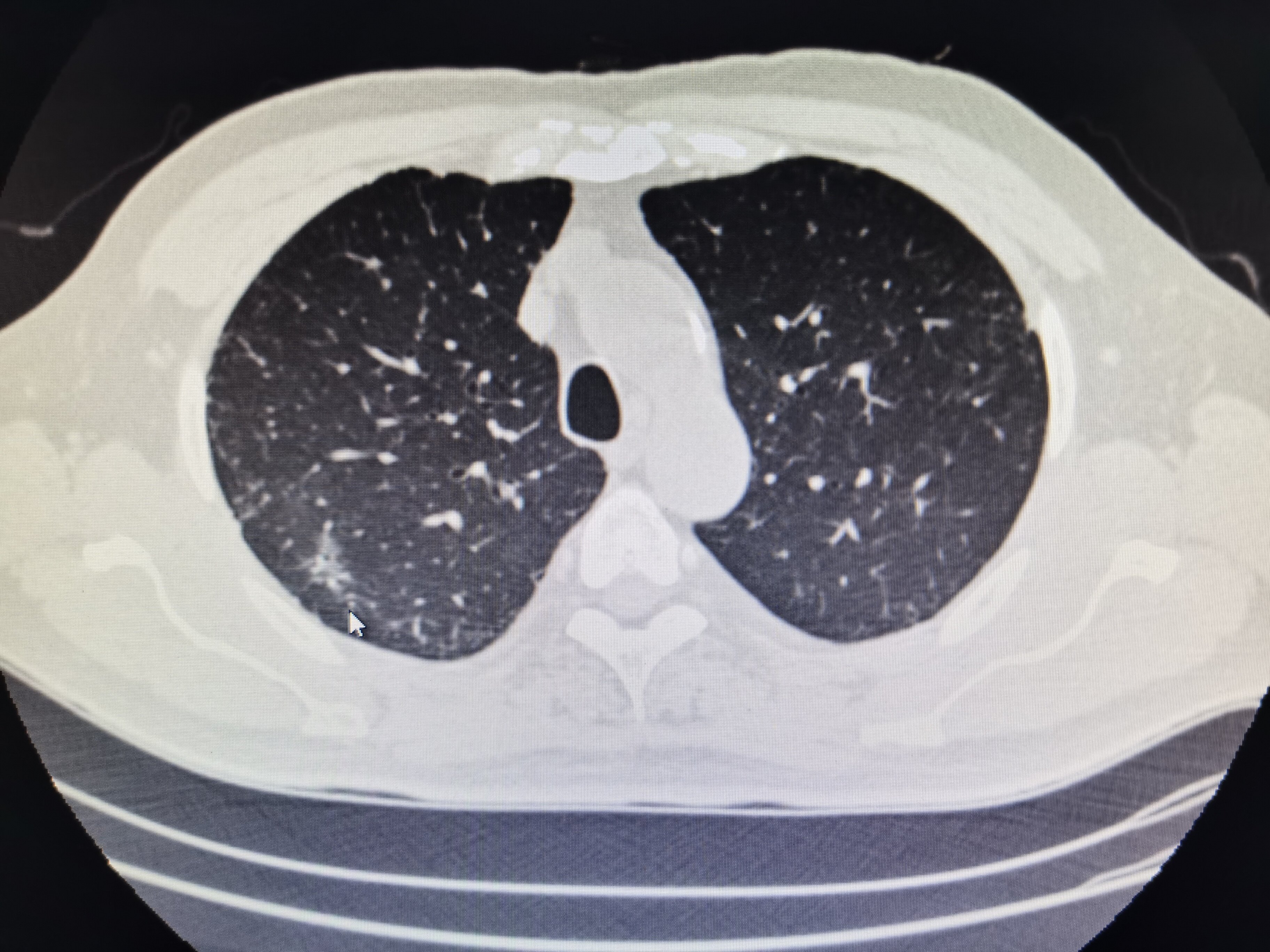 肺部结节 肺部结节