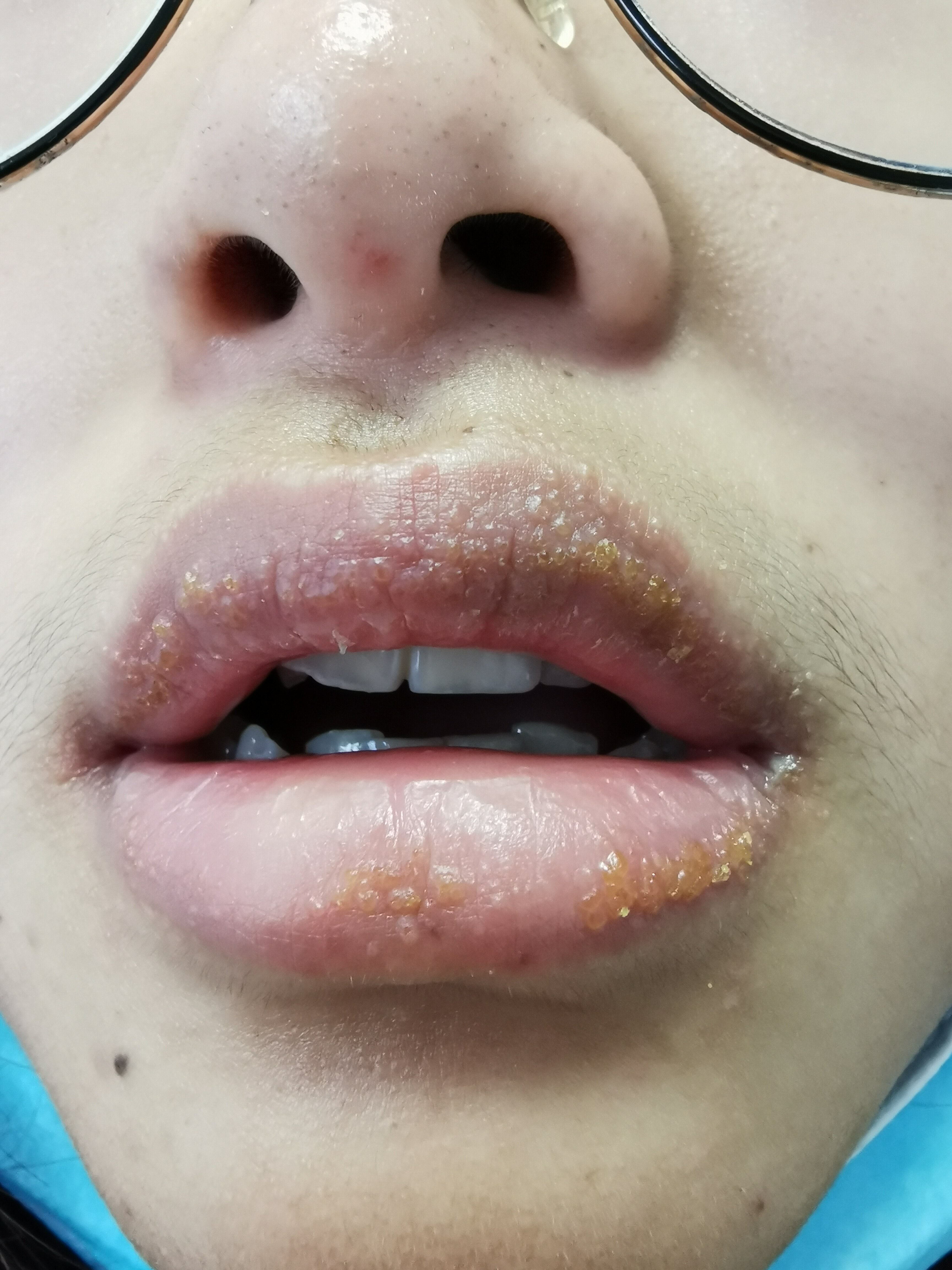 口周湿疹初期图片