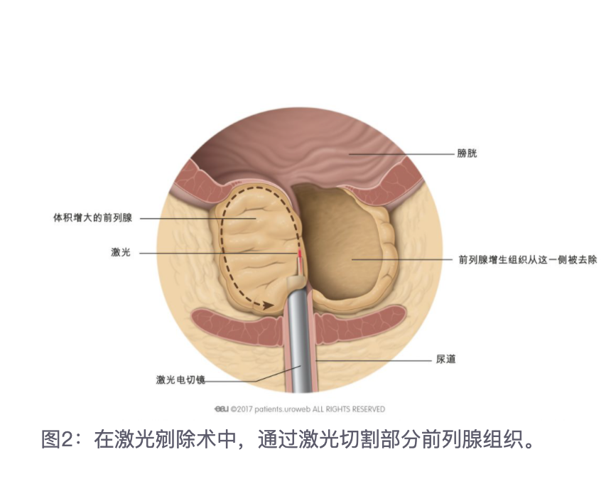 前列腺增生手术知多少(三)经尿道前列腺激光剜除术及术后注意事项!