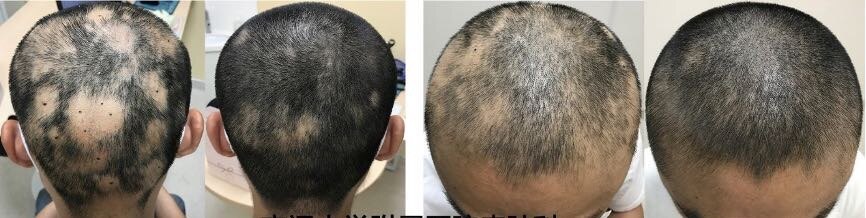 "鬼剃头"——是"谁"剃了你的头发?