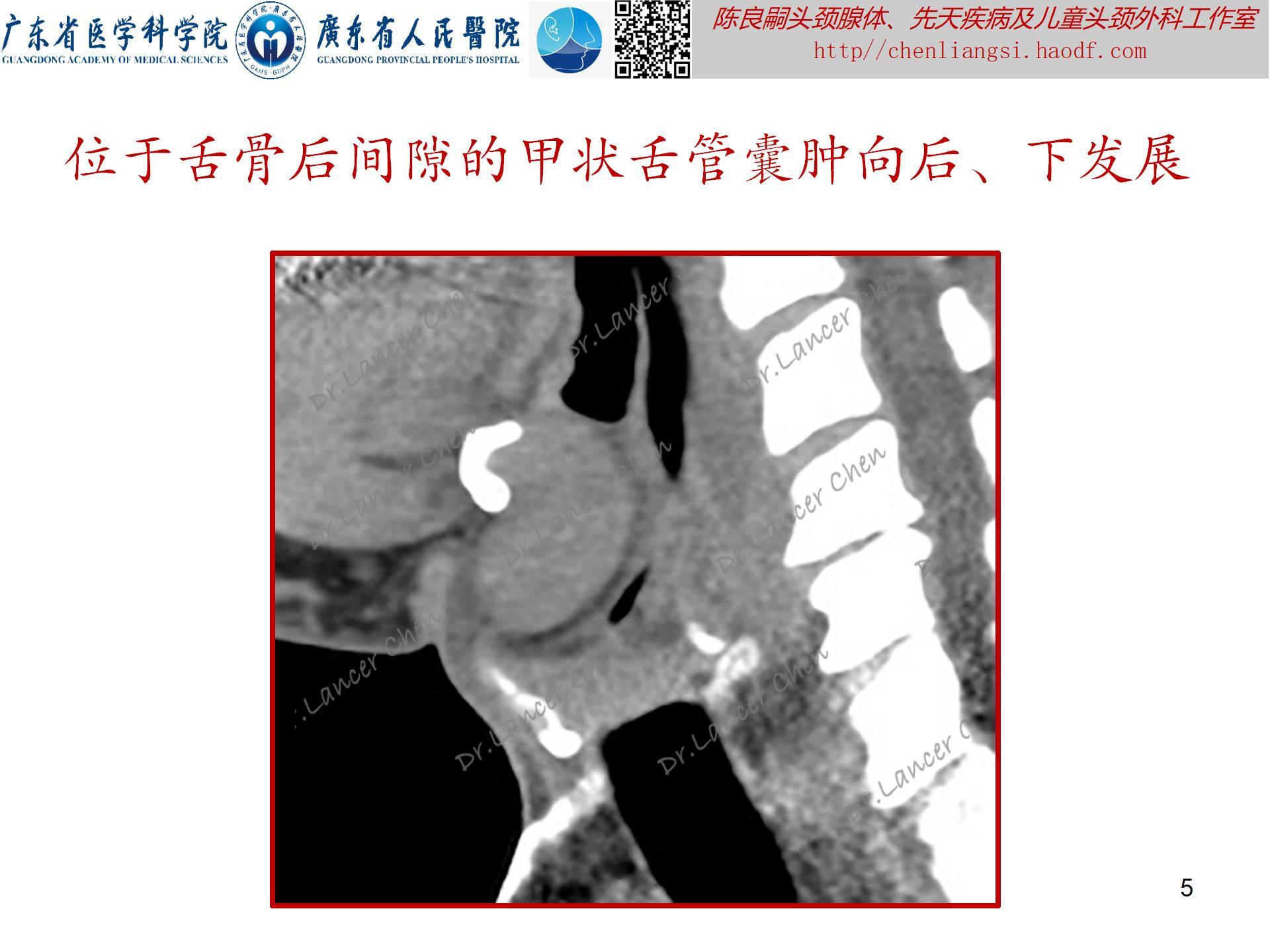 20240621：医学科普——百密一疏：舌骨后间隙的忽略，可导致甲状舌管囊肿术后复发_05.jpg