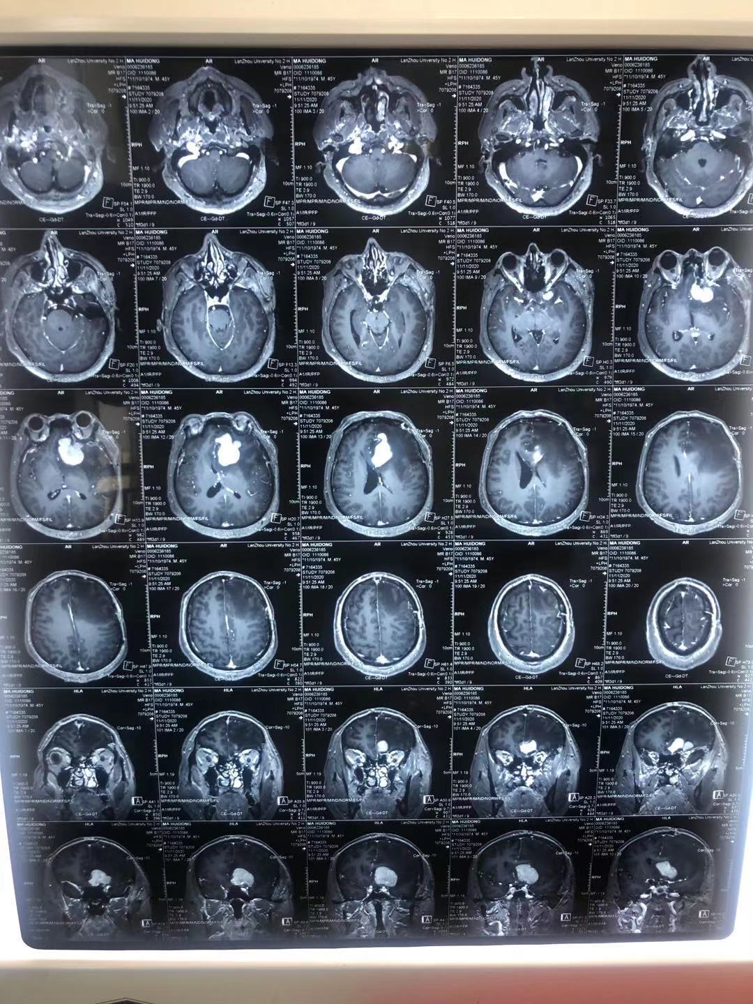 脑淋巴瘤图片