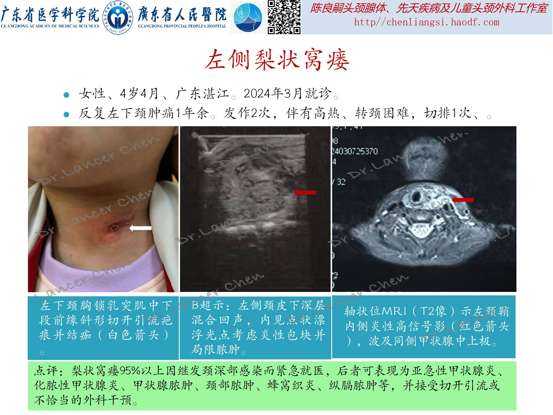 20240810：看图识病——左侧梨状窝瘘 - 好大夫在线