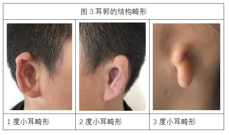 先天性小耳畸形的听觉重建与耳郭再造术_小耳畸形_介绍_治疗方式 - 好