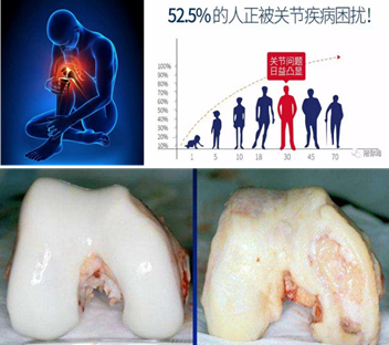 3d打印与干细胞技术助力膝关节软骨损伤治疗与康复 膝关节损伤 3d打印与干细胞技术助力膝关节软骨损伤治疗与康复 膝关节损伤