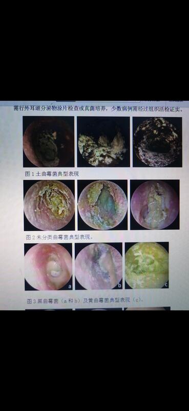 人耳朵里长真菌图片图片