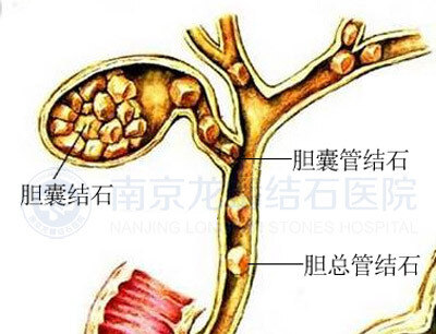 (3)黄疸:结石落入胆总管或嵌顿于胆囊颈部的结石压迫胆总管均可造成