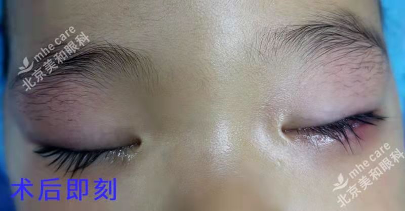 莫把霰粒肿当麦粒肿延误治疗 Eos超脉冲新疗法非手术治疗 霰粒肿 饮食运动 症状