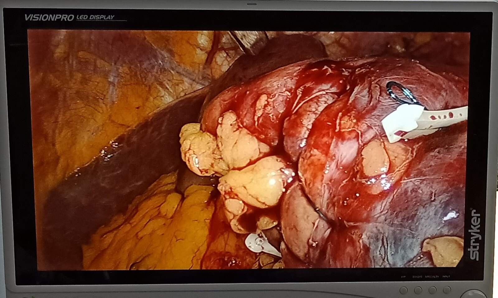 肾肿瘤微创手术分享1----腹腔镜肾部分切除术病例 - 好大夫在线