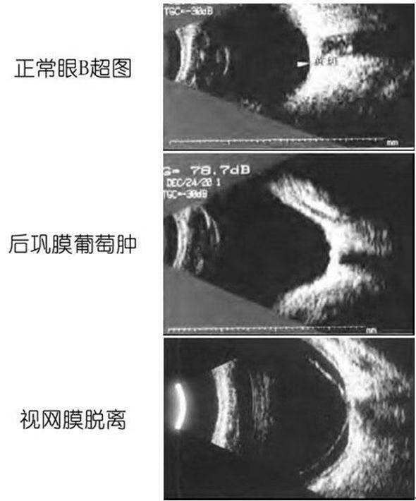 的眼轴延长,球壁就会像"吹气球"一样被撑得越来越薄,出现后巩膜葡萄肿