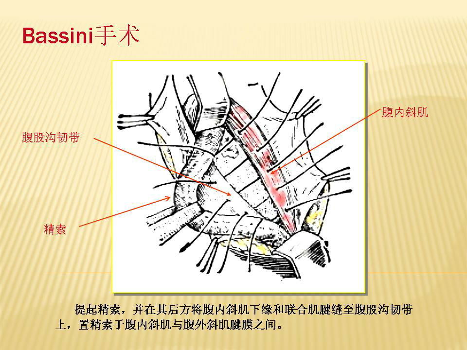 涌现出200多种手术方法,最具典型意义的手术,如1889年的halsted的手术