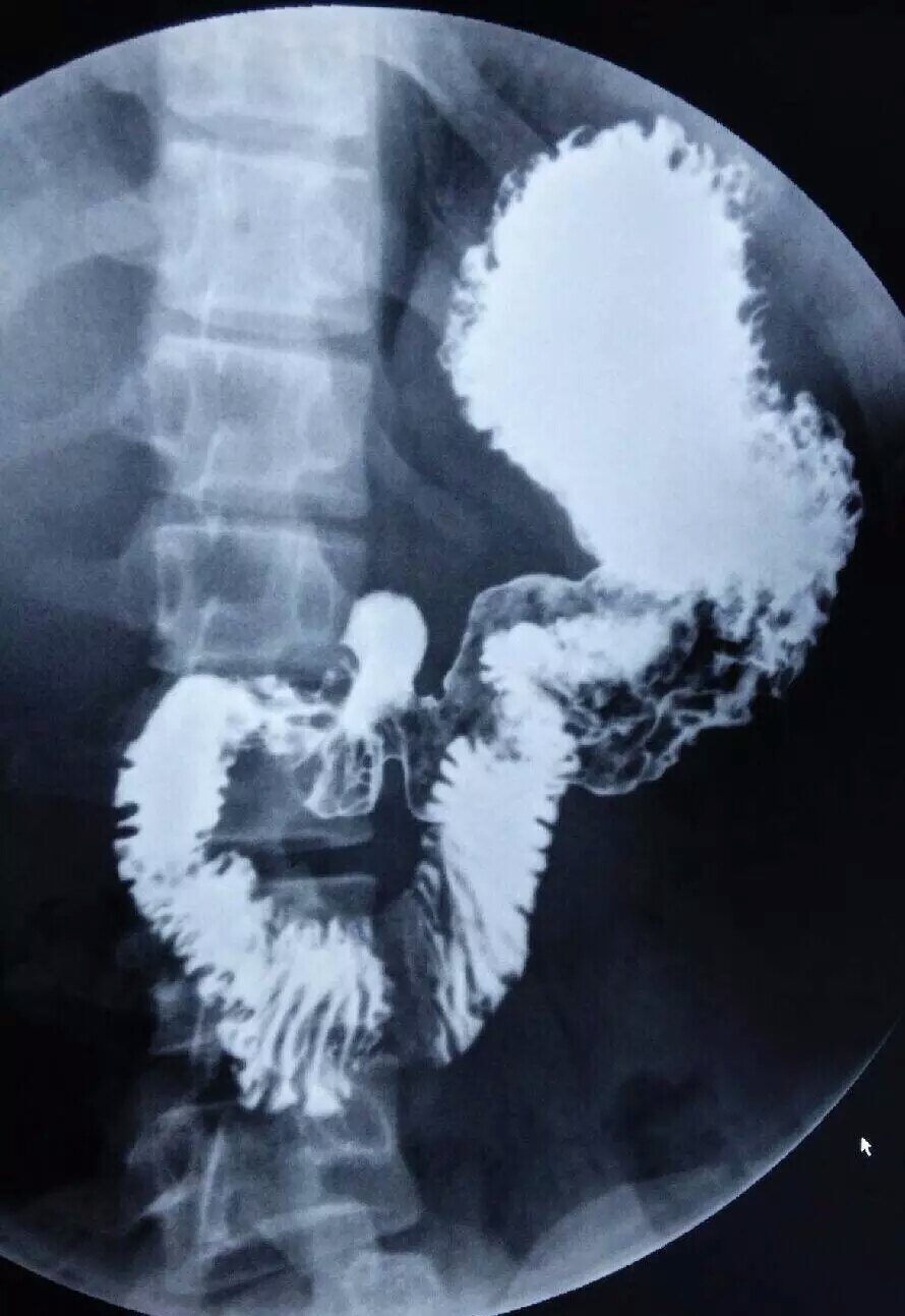 上消化道造影是怎么回事?你都知道吗? - 好大夫在线