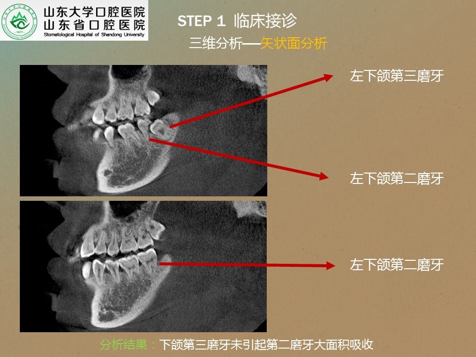 疑難複雜牙拔除系列1——第二磨牙根方的骨埋伏阻生牙