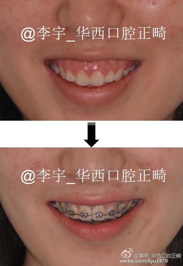 露龈笑需要全面诊断分析,针对病因施治,该手术的手术,该正牙的正牙